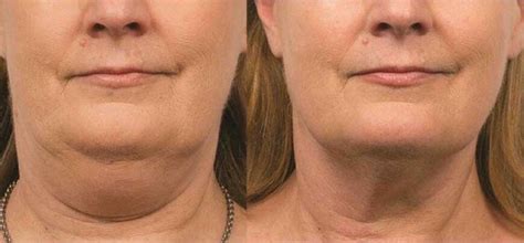 Best Double Chin Treatments In Brisbane .